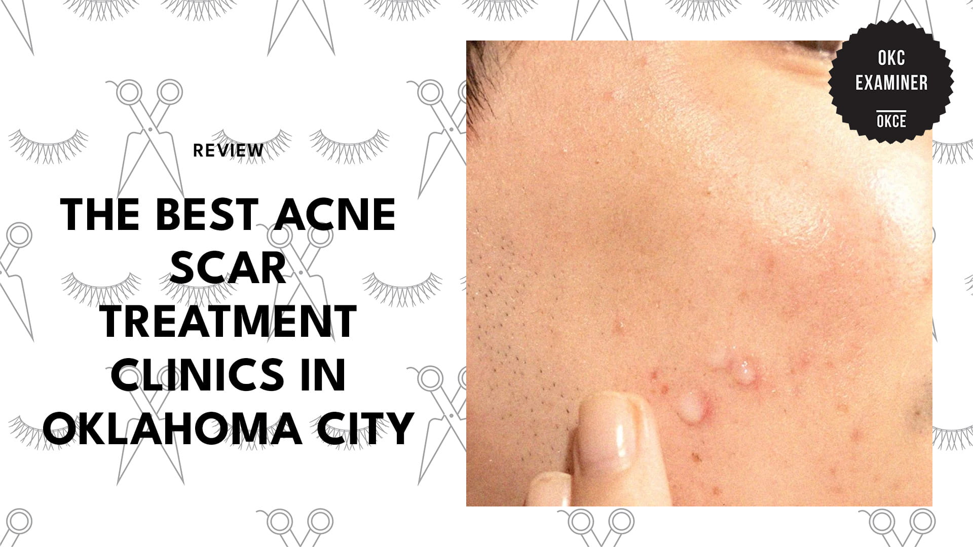 acne-scar-treatments-oklahoma-city-banner
